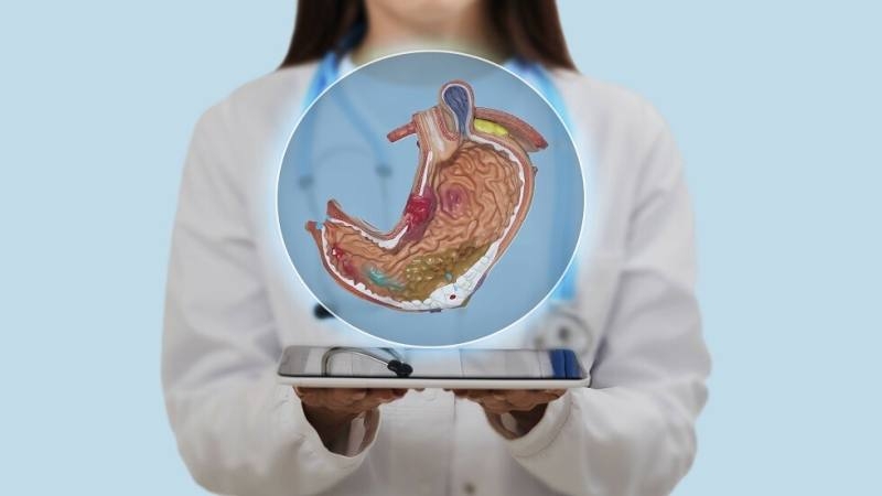 أطعمة ومواد غذائية تسبب قرحة المعدة