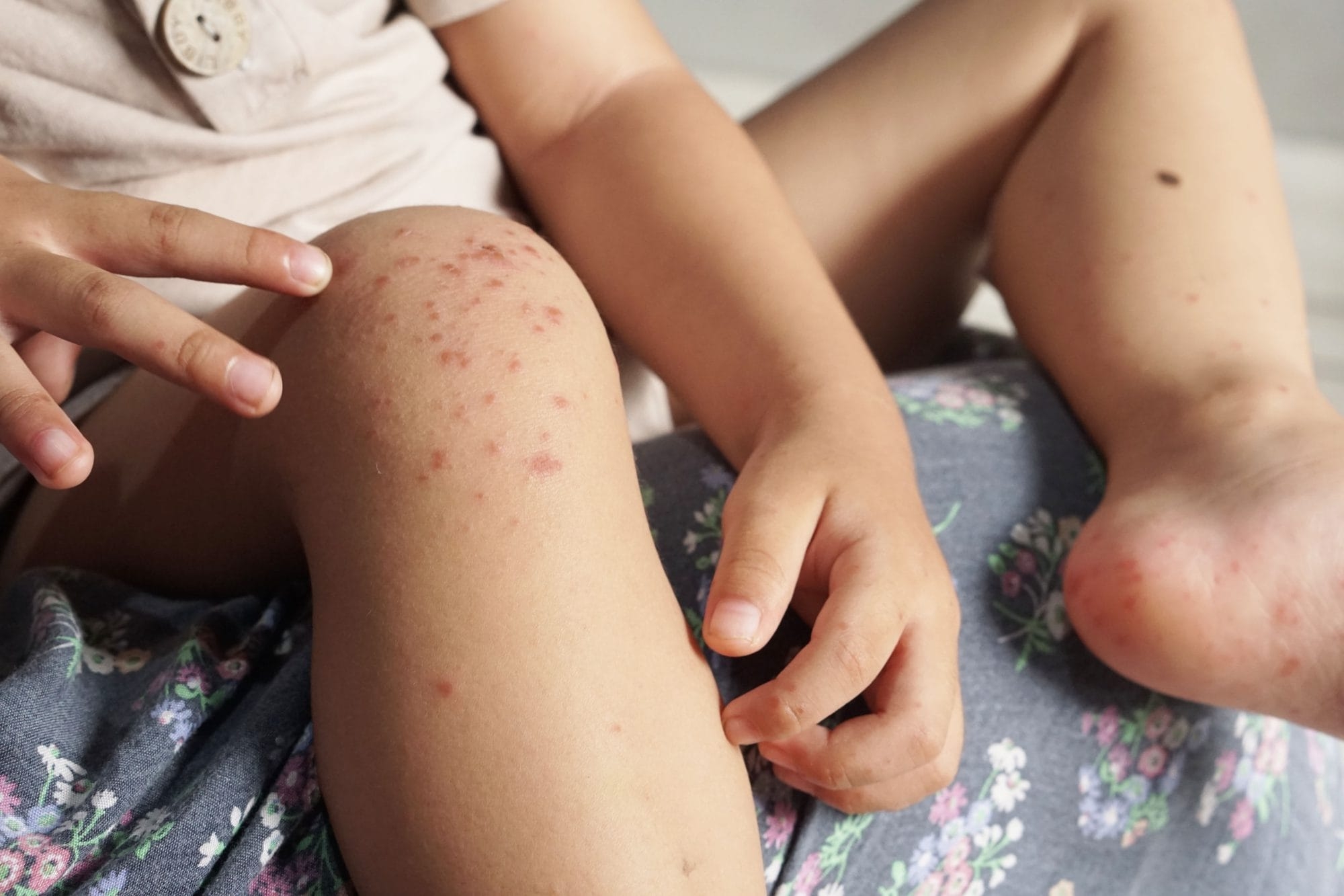 Facts Prevention Tips For Hand, Foot And Mouth Disease
