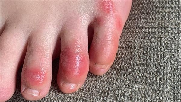8 علامات تحذيرية تكشف أمراضًا خطيرة في قدمك