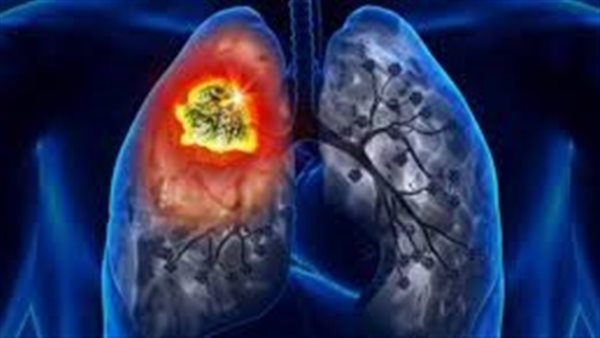 غير المدخنين وسرطان الرئة.. ما هي الأسباب الخفية للمرض؟