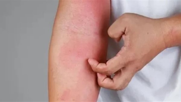 الذكاء الاصطناعي يكشف شامة مريبة.. هل أصبح أداة فعالة في رصد السرطان؟