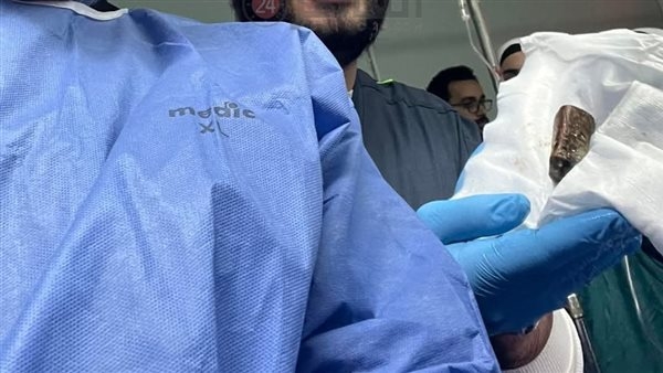 ظلت في معدته 18 شهرًا.. استخراج 3 حجارة قلم من بطن مريض بالمنوفية