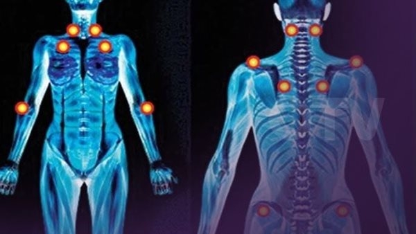 حالة مزمنة تسبب آلام عضلية.. ما هو مرض الفايبروميالجيا؟