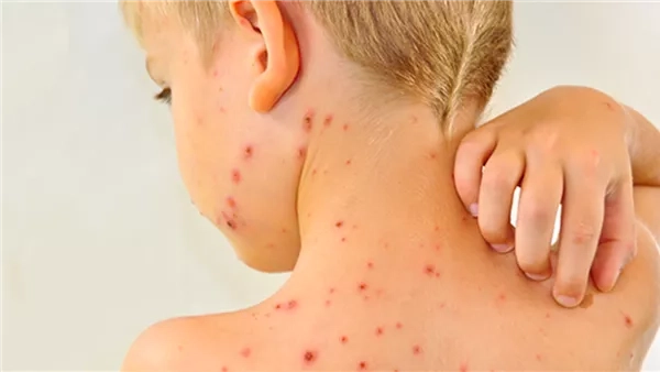 أمريكا تسجل ارتفاعا في حالات الإصابة بالحصبة
