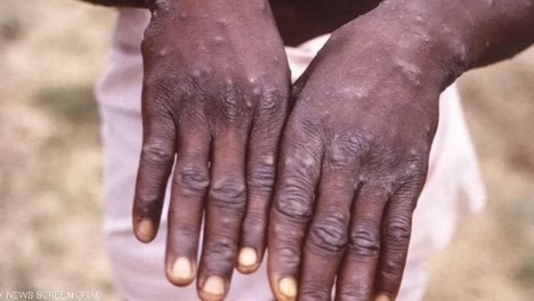 بعد تحذيرات من تفشي الفيروس عالميًا، وفاة أول حالة مصابة بجدري القرود في غانا