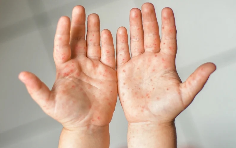 Week 17 shows 99,601 hand, foot and mouth disease cases reported nationwide