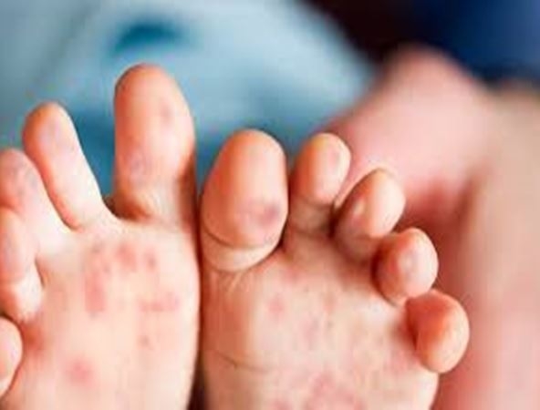 Parents, caregivers advised to remain cautious of HFMD during school holidays