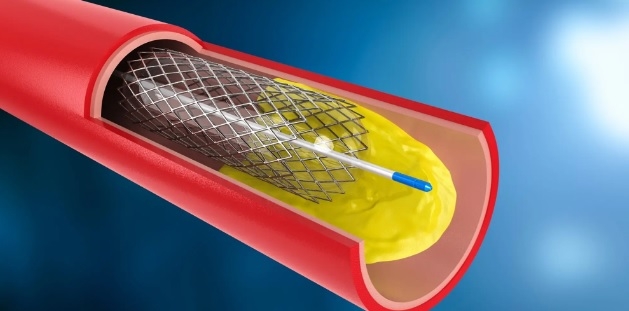 60-70pc patients require stenting