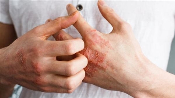 "الإكزيما" مرض جلدي يهدد 20% من الأطفال.. كيف نحمي صغارنا ؟