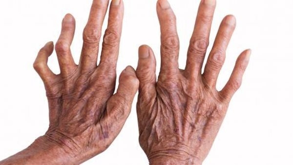 في اليوم العالمي للجذام.. الدواء تقدم نصائح حول التوعية والتشخيص المبكر