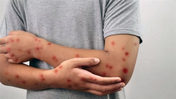 كيف نجحت وزارة الصحة في تجديد شهادة خلو مصر من الحصبة؟