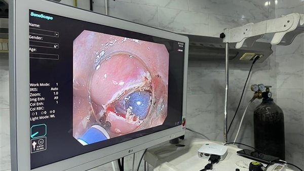 لأول مرة.. إجراء عمليات متطورة بتقنية الفراغ الثالث بالشرقية