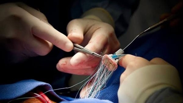لأول مرة.. استئصال ورم في العمود الفقري عبر العين