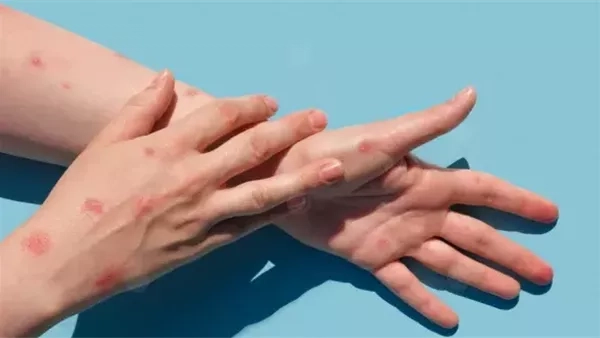 أستاذ أمراض جلدية يكشف سبب ظهور بقع حمراء فى الوجه والجسم