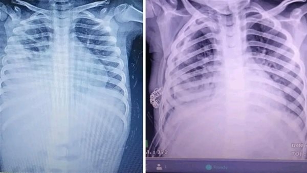 نجاح عملية "تقشير الغشاء البلوري"لطفل بمستشفى برج العرب