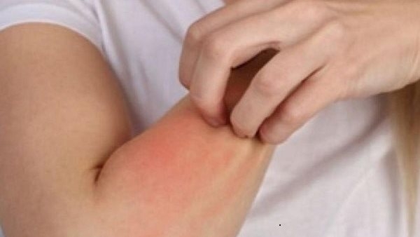 حساسية الطقس: الأسباب والعلاج وأفضل طرق الوقاية!
