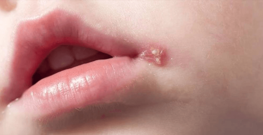 أسباب إصابة الأطفال بـ الهربس.. الأعراض والعلاج