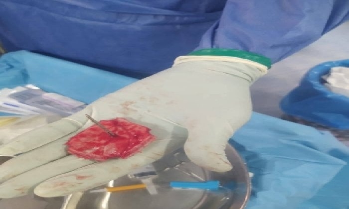 استخراج مسمار من جمجمة طفل دون إصابة المخ بالفيوم