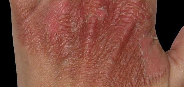 بشرى سارّة لأصحاب الحروق.. دواء قد يسرع التئام جروحكم