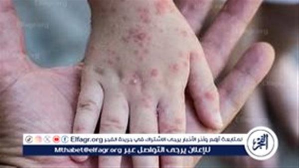 الصحة العالمية تحذر من تفشي جدري القرود في سيراليون