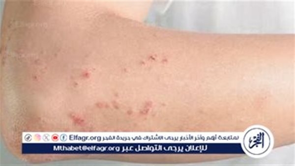 كل ما تريد معرفته عن لقاح الحزام الناري: الفوائد والجرعات والموانع