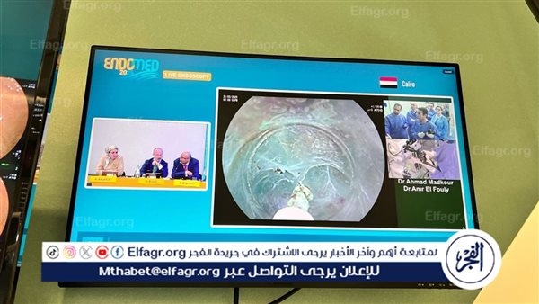 إنجاز طبي عالمي لجامعة حلوان: بث حي لجراحة بالمنظار يحصد إشادة دولية