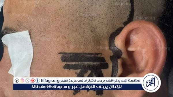 نتيجة اندماج العظام والأنسجة.. جراحة دقيقة وغير مسبوقة لشاب بمستشفى العامرية في الإسكندرية