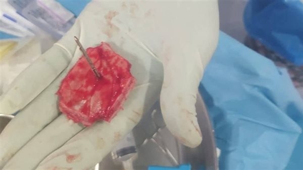إنجاز طبي جديد بمستشفيات جامعة الفيوم: استخراج جسم معدني خطير من جمجمة طفل دون مضاعفات