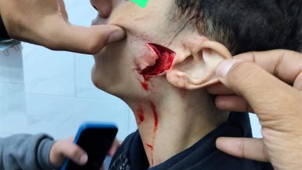 بعد الاعتداء عليه بزجاجة مكسورة فى "وشه" 21 غرزة لطالب بالصف الأول الثانوي