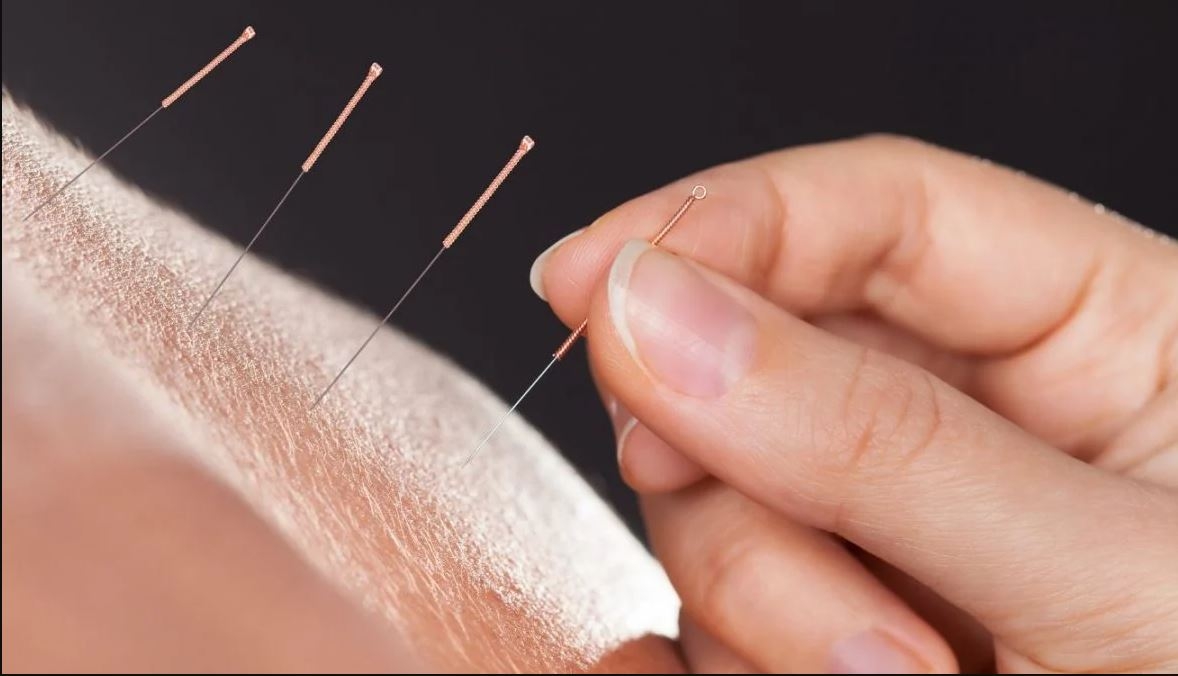 نهاية مأساوية بعد جلسات علاج بالأبر الصينية