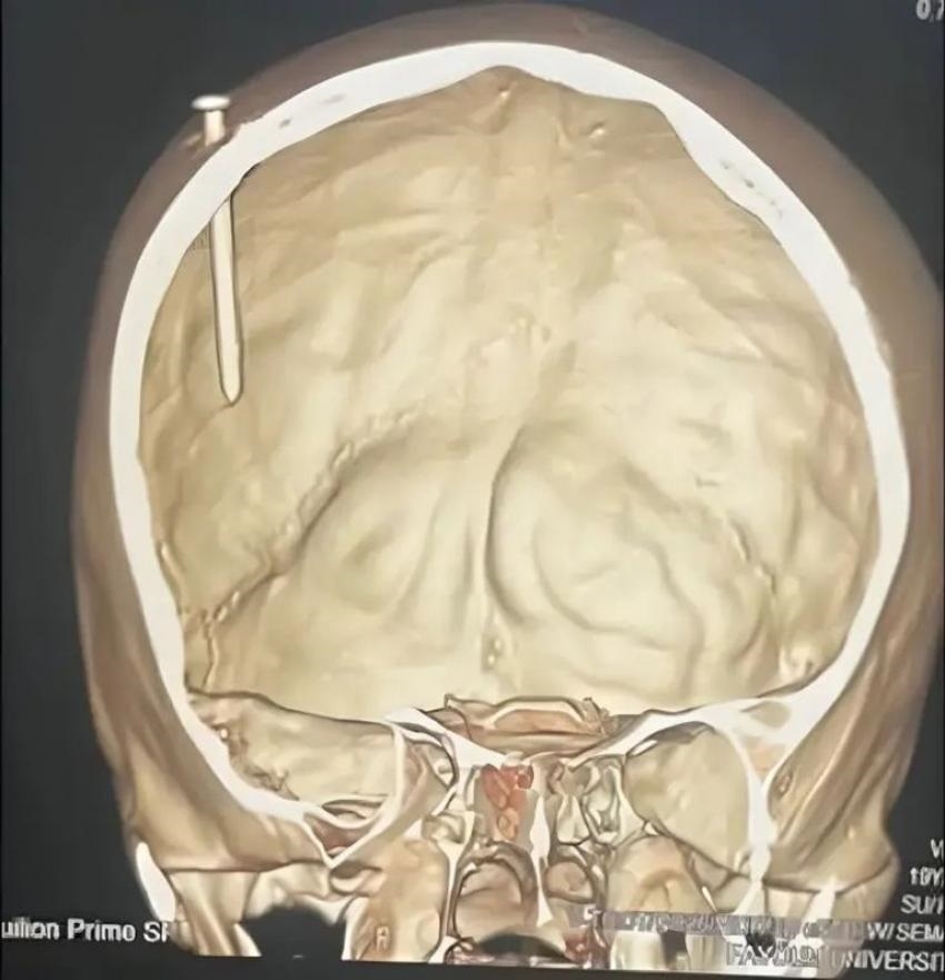 5 ساعات في غرفة العمليات لإخراج مسمار من رأس طفل مصري