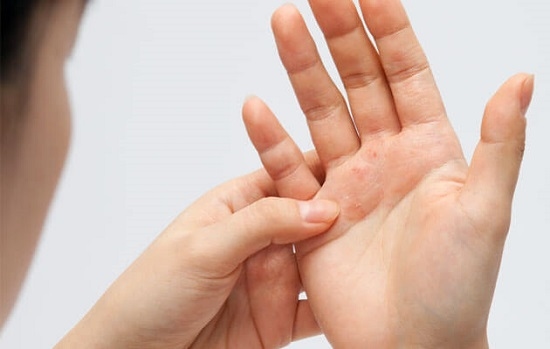 ما علاقة الإكزيما بأمراض الكلى المزمنة؟