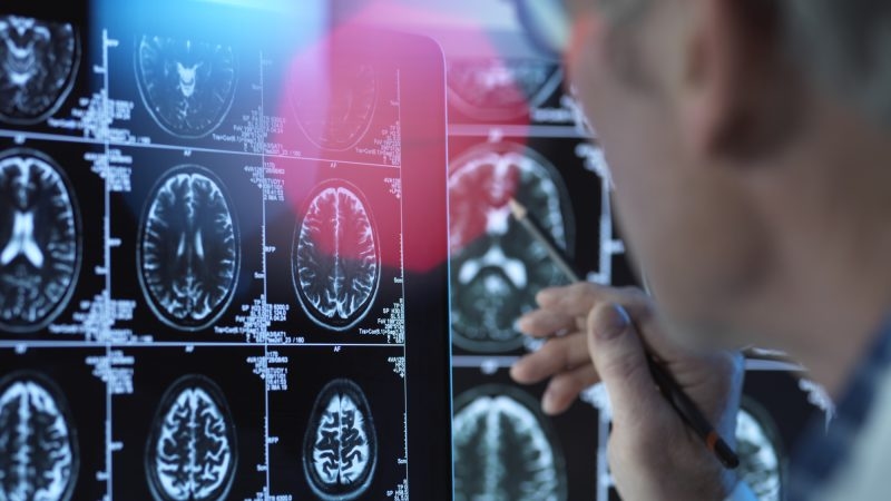 ‘Rethink brain health', say experts battling EU Alzheimer's crisis