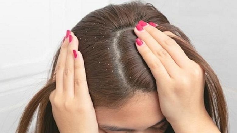 مكونات طبيعية من مطبخك لعلاج القشرة