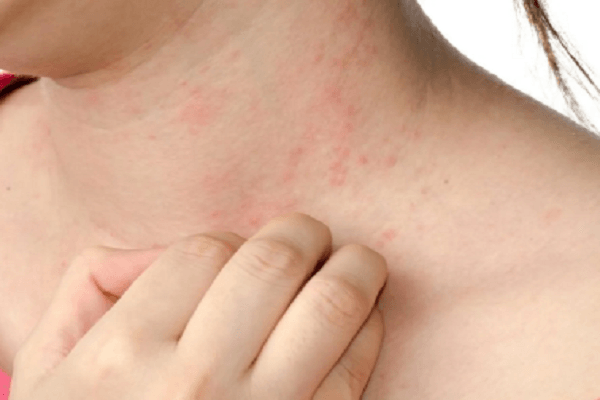 تعرف على اسباب وأعراض وعلاج الإكزيما