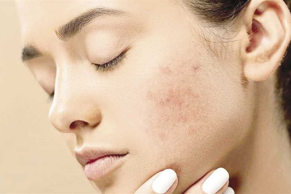 لماذا تظهر الحبوب رغم اهتمامك ببشرتك؟ .. إليك الأسباب