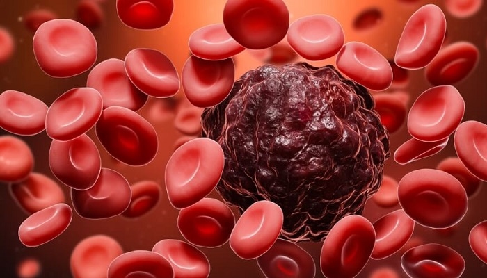 شريحة دقيقة تفتح آفاقًا جديدة لعلاج مخصص لسرطان الدم