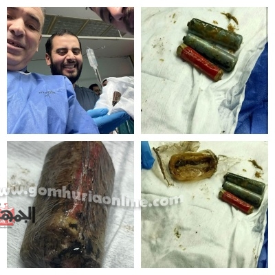 معجزة طبية بالمنوفية: استخراج حجارة ريموت من معدة مريض بدون جراحة