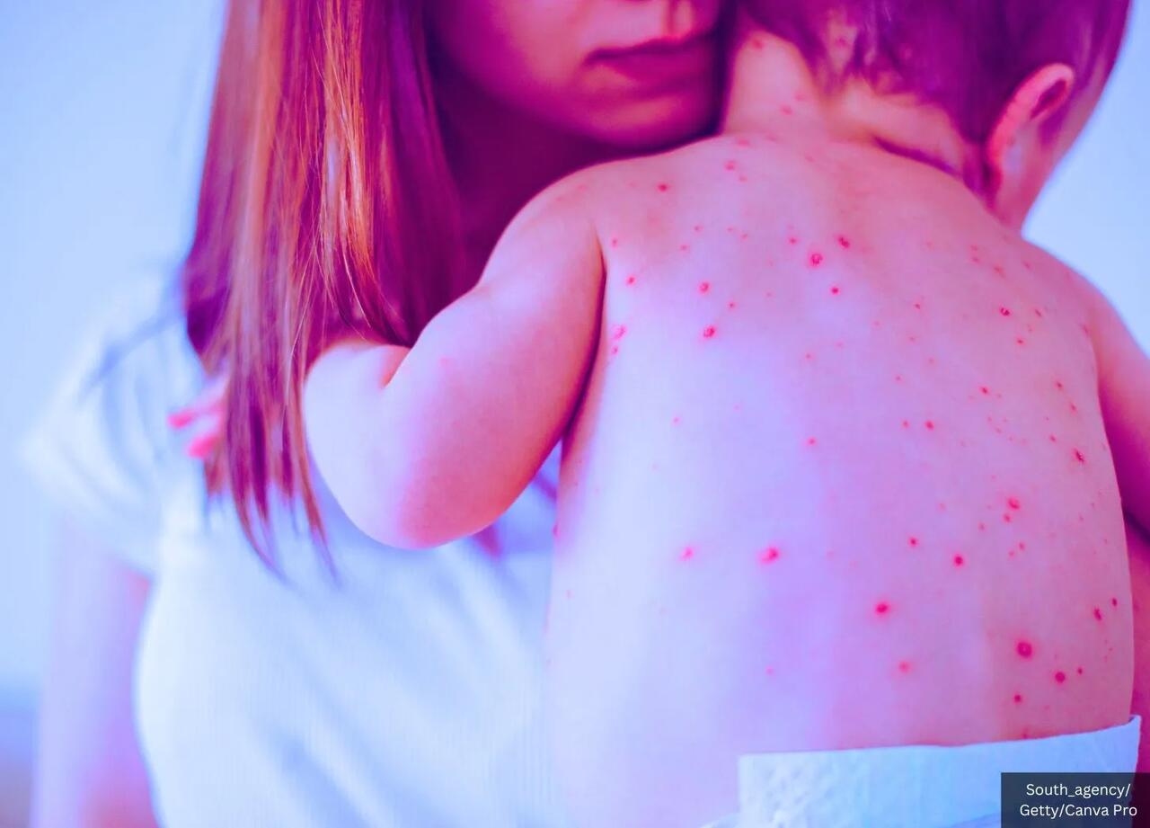 Texas Gave 15,000 More MMR Shots This Year - Now It Has More Measles Cases Than the Entire US Had In 2024