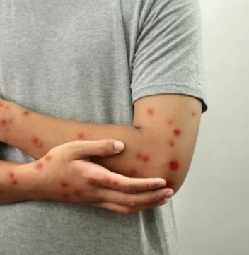 Ghana Reports Worst Monkeypox Outbreak Since 2022