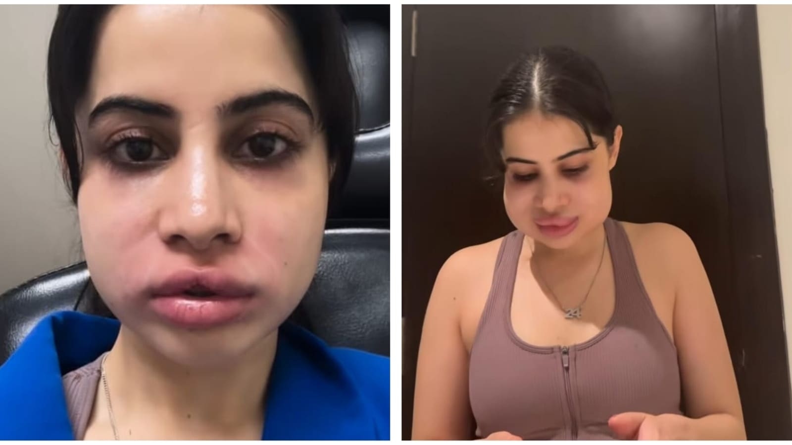 Uorfi Javed gives it back to trolls as she pokes fun at her swollen face after dissolving lip fillers