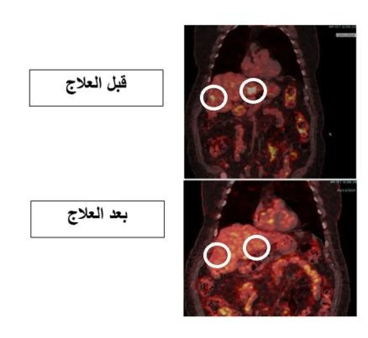 إنجاز طبي جديد في مستشفى الملك المؤسس