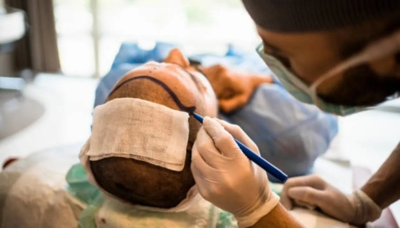 قبل عملية زراعة الشعر.. وفاة غامضة لبريطاني في إسطنبول