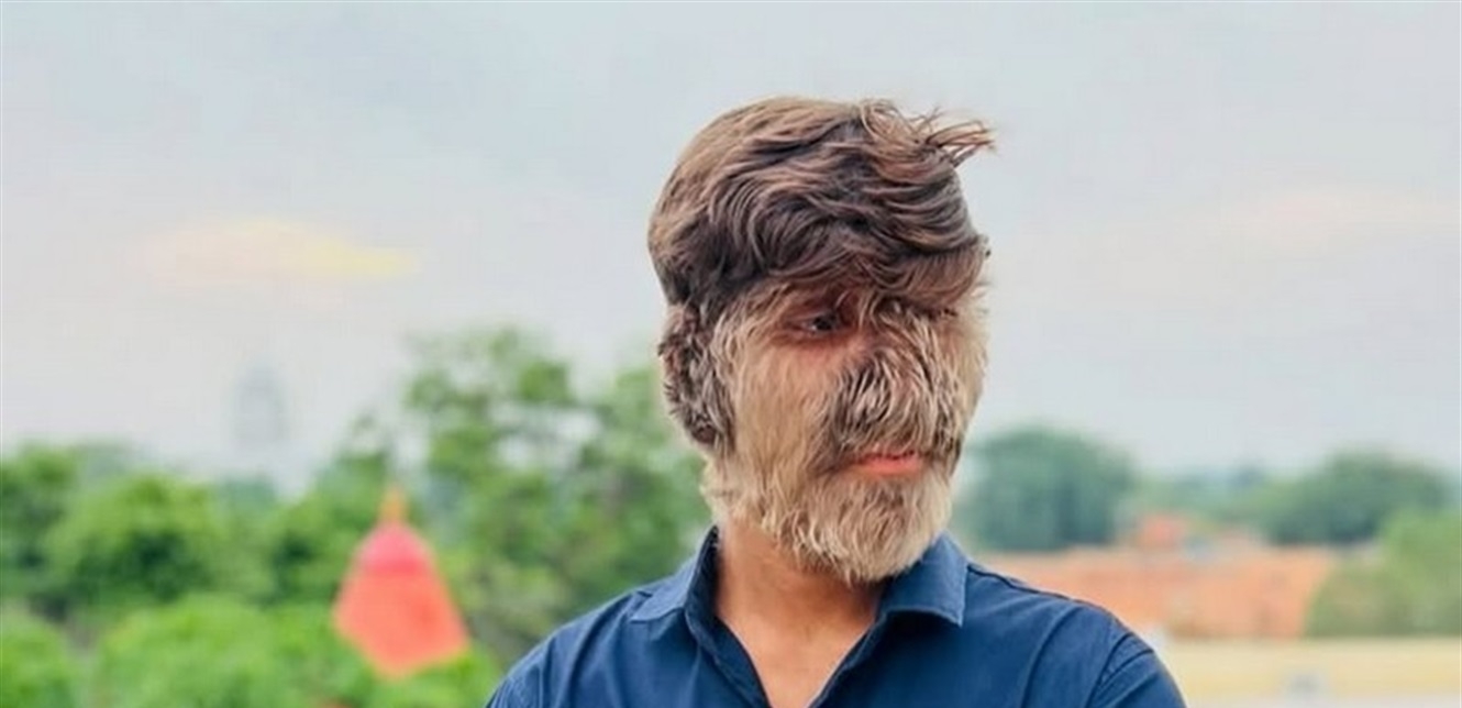 عمره 18 عاما.. هندي يدخل موسوعة غينيس بسبب كثافة شعر وجهه (صور)