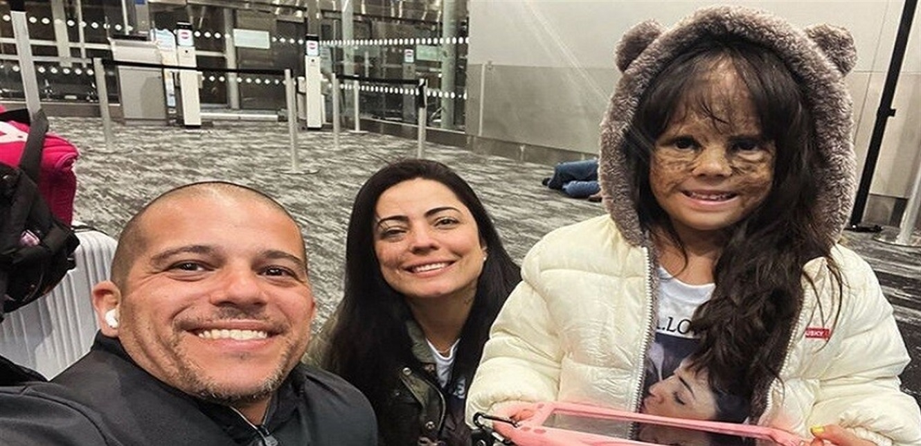 من أميركا إلى روسيا.. طفلة تواجه "الوحمة النادرة" بجراحة دقيقة