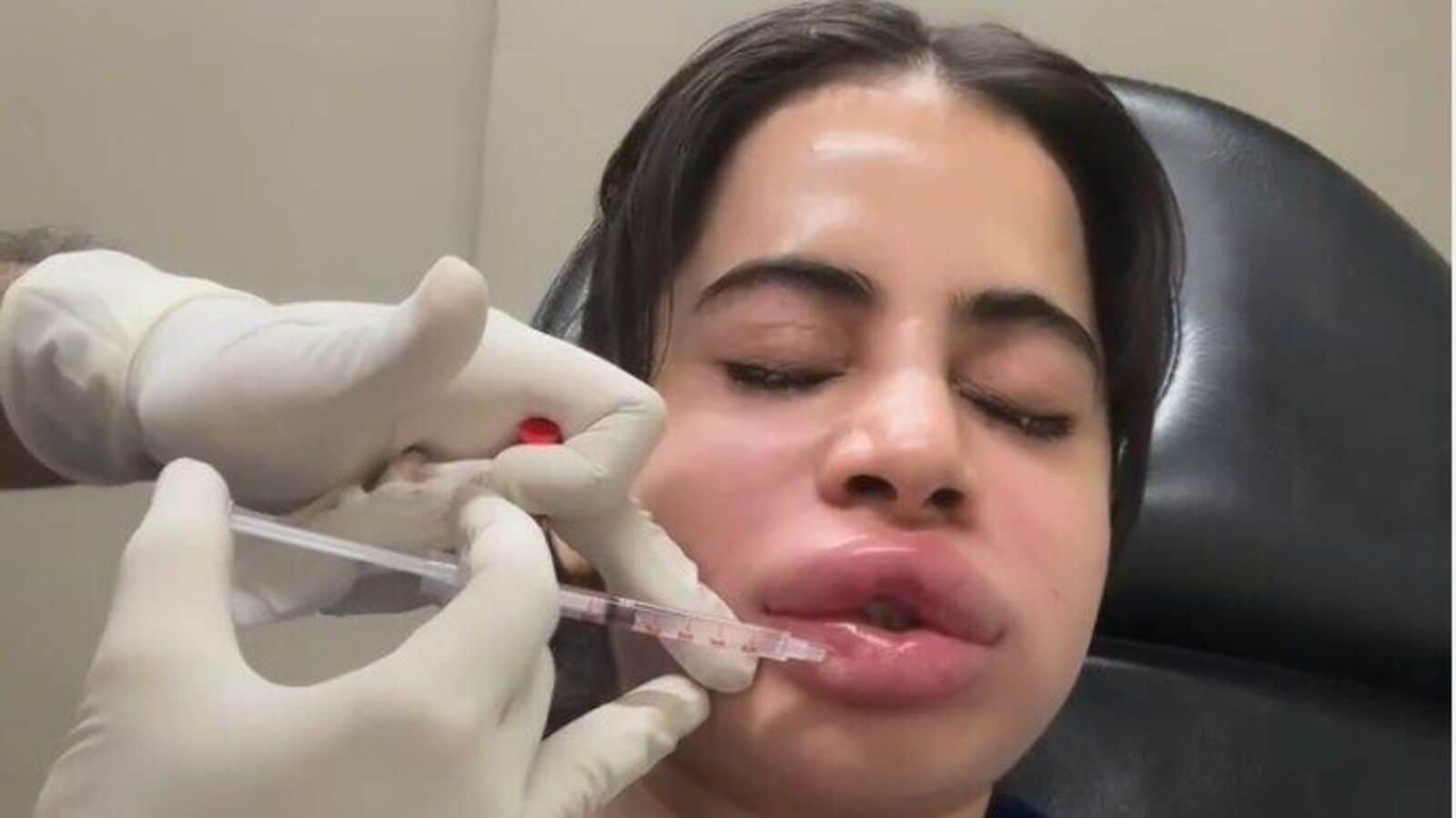 Why did Uorfi Javed get her lip fillers dissolved? Expert warns, 'Extraction is…'