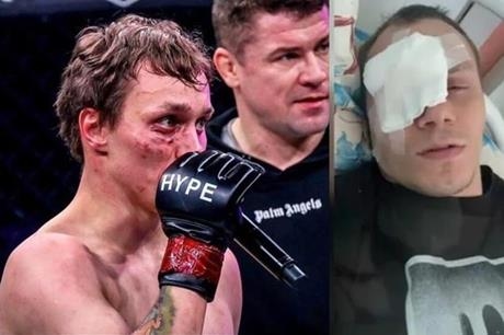 حادثة صادمة.. مقاتل MMA يفقد عينه في عراك مع فتاة