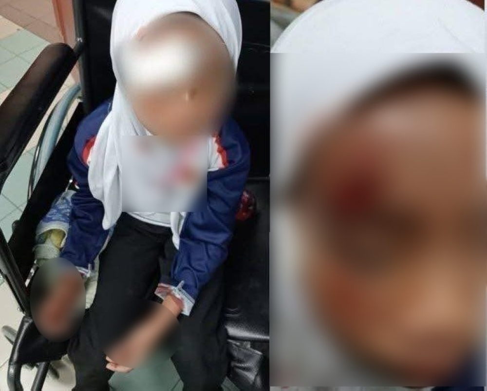 Melaka hit-and-run leaves young girl with deep gash on forehead, police investigating