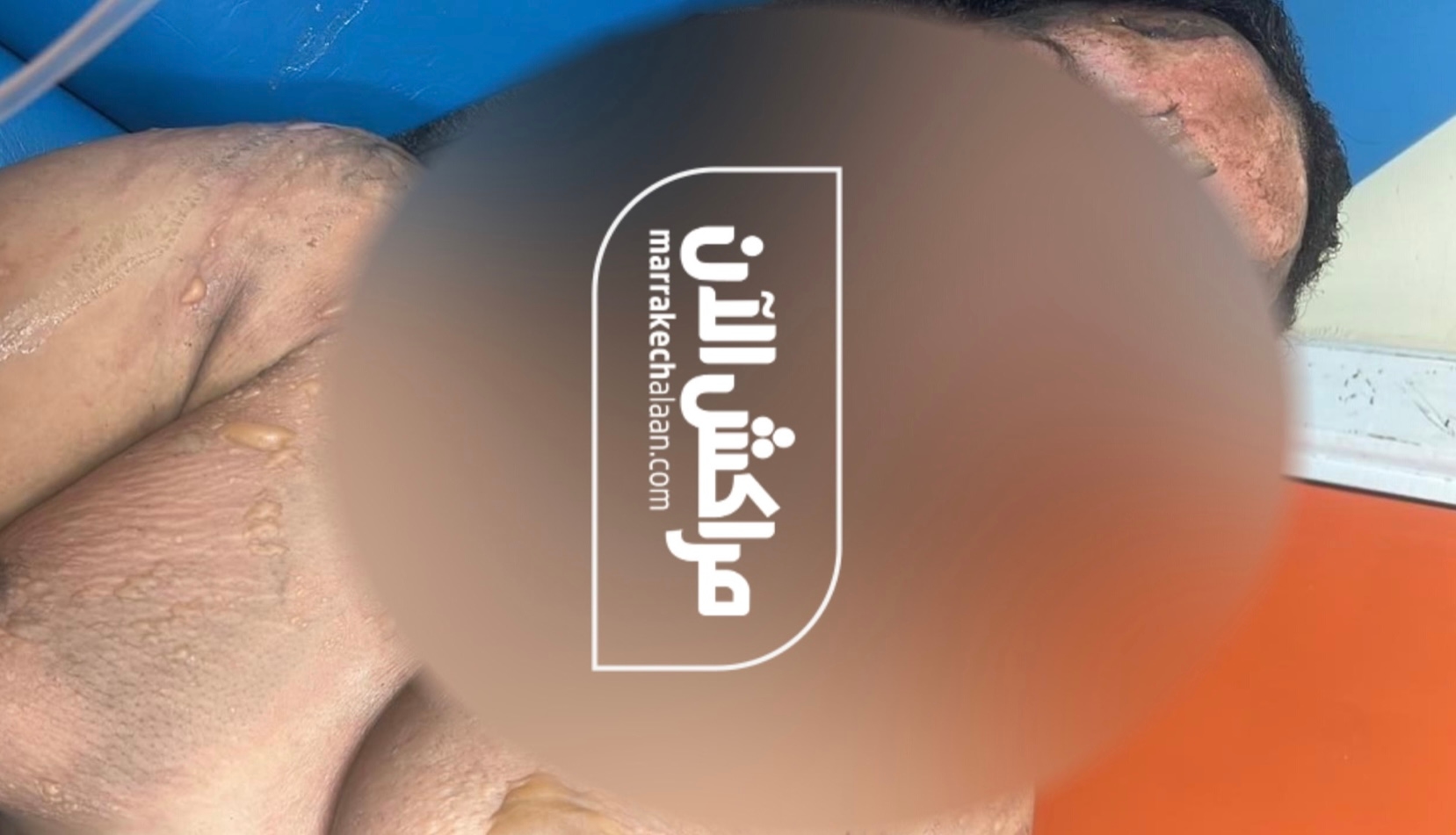 'مراكش الآن' تكشف تطورات قضية فتاة جليز.. اعتقال متورطين في جريمة حرقها