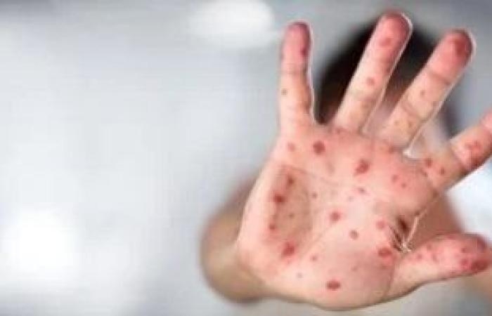 الصحة العالمية تصدر إرشادات جديدة للوقاية من جدرى القرود